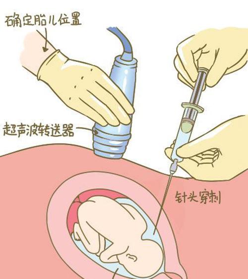 德阳羊水孕期亲子鉴定